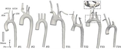 Hemodynamic Abnormalities in the Aorta of Turner Syndrome Girls